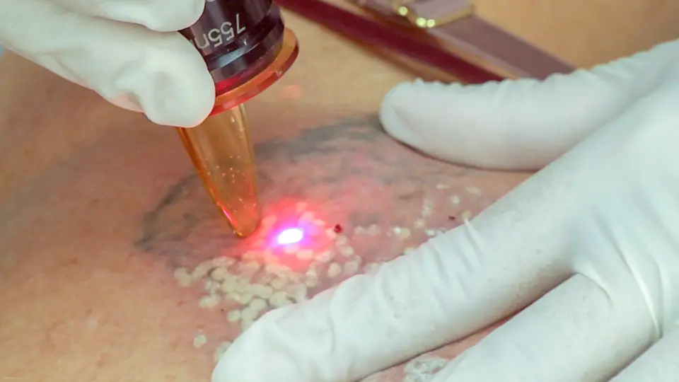 Sesión de eliminación de tatuaje con láser en curso