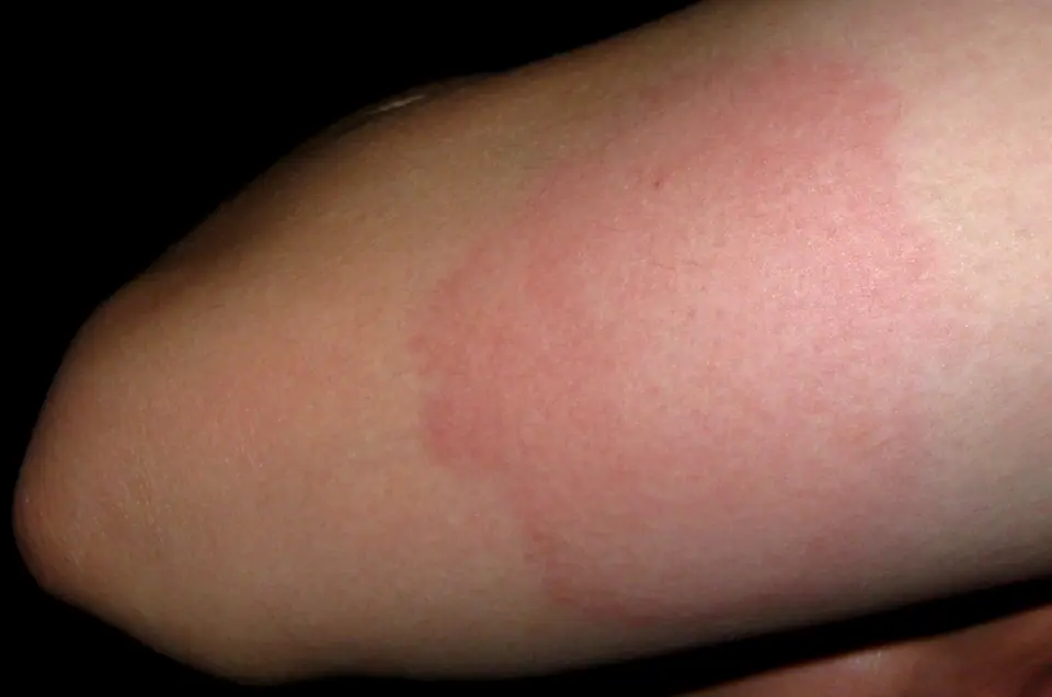 Piel del brazo enrojecida e inflamada, similar a una reacción cutánea