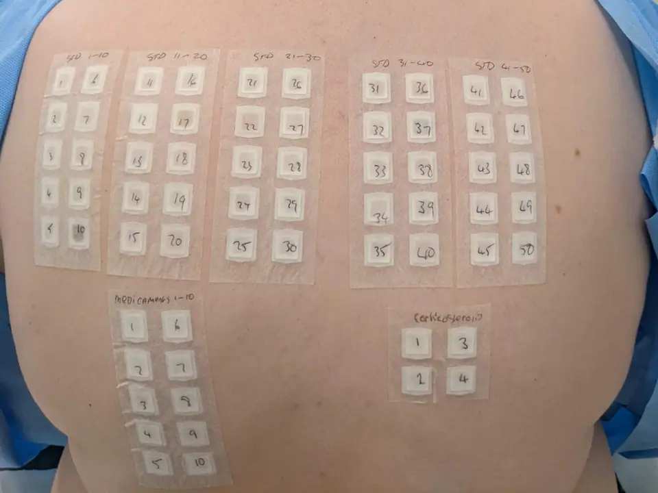 Prueba de parche con cuadrícula de parches adhesivos sobre la piel de la espalda